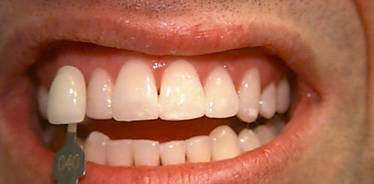 Teeth Whitening Case 2 after