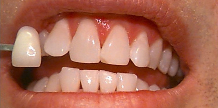 Teeth Whitening Case 3 Before