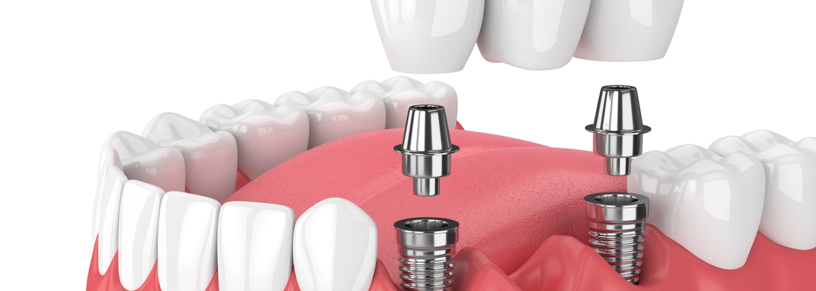 A 3D illustration of dental implants in the lower jaw, showing implant posts in the gum and a dental bridge about to be placed on top.