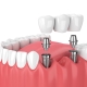 A 3D illustration of dental implants in the lower jaw, showing implant posts in the gum and a dental bridge about to be placed on top.
